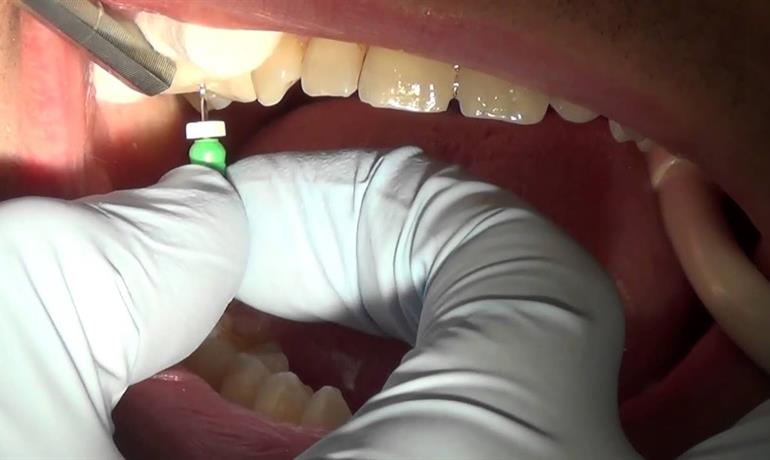 مراقبت‌های بعد از عصب کشی دندان